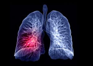 Affected respiratory system rendering