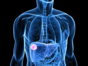 Liver cancer rendering