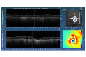 Voxeleron a Voiant company Orion platform SaaS software Ai-driven OCT image analysis GA geographic atrophy grading heatmap ophthalmology reading center workflow automated deep learning Diagnostics journal MDPI
