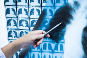 Integrated ILD and RECIST Voiant clinical trial imaging solutions AI-powered imaging CRO dual assessments radiology and pulmonology for ADC program