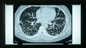 High-Resolution Computed Tomography (HRCT) HRCT Lung Honeycomb Pattern Lightbox — Pulmonary Fibrosis Radiology Stock Photo for ADC Oncology trials imaging CRO safety monitoring AI generated ILD interstitial lung disease lung toxicity central review BICR endpoint adjudication